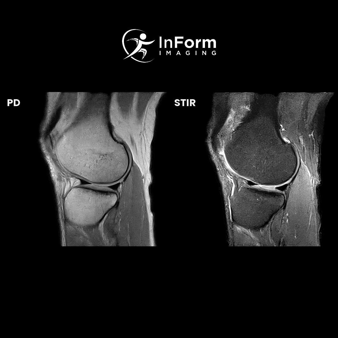 Knee MRI scan showing PD and STIR sequences at InForm Imaging